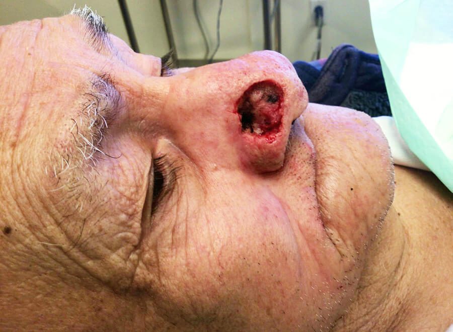 Mohs Nose Patient 27 After
