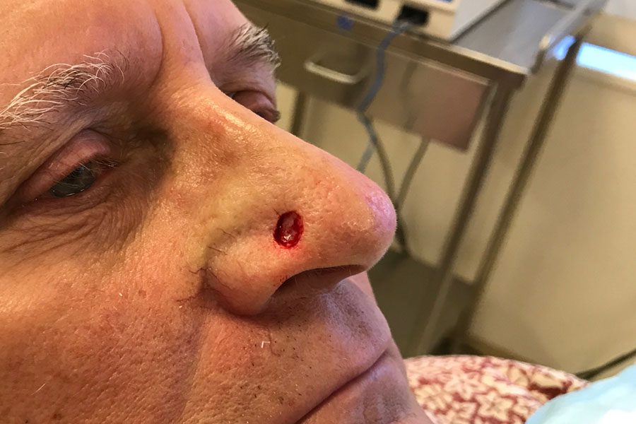 Mohs Nose Patient 28 After