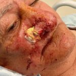 Mohs Nose Patient 27 Thumbnail Before - 2