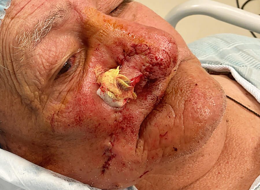 Mohs Nose Patient 27 Before - 2