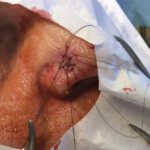 Mohs Nose Patient 28 Thumbnail Before - 2