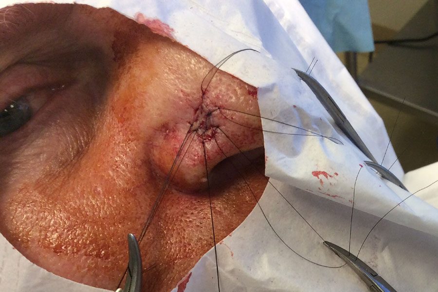 Mohs Nose Patient 28 Before - 2