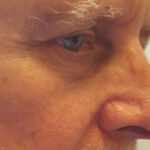 Mohs Nose Patient 28 Thumbnail After - 2