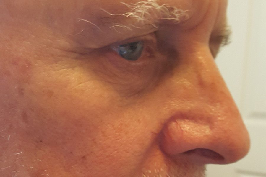 Mohs Nose Patient 28 After - 2