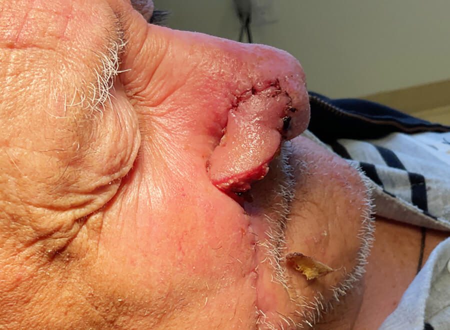Mohs Nose Patient 27 After - 2