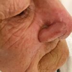 Mohs Nose Patient 27 Thumbnail Before - 3