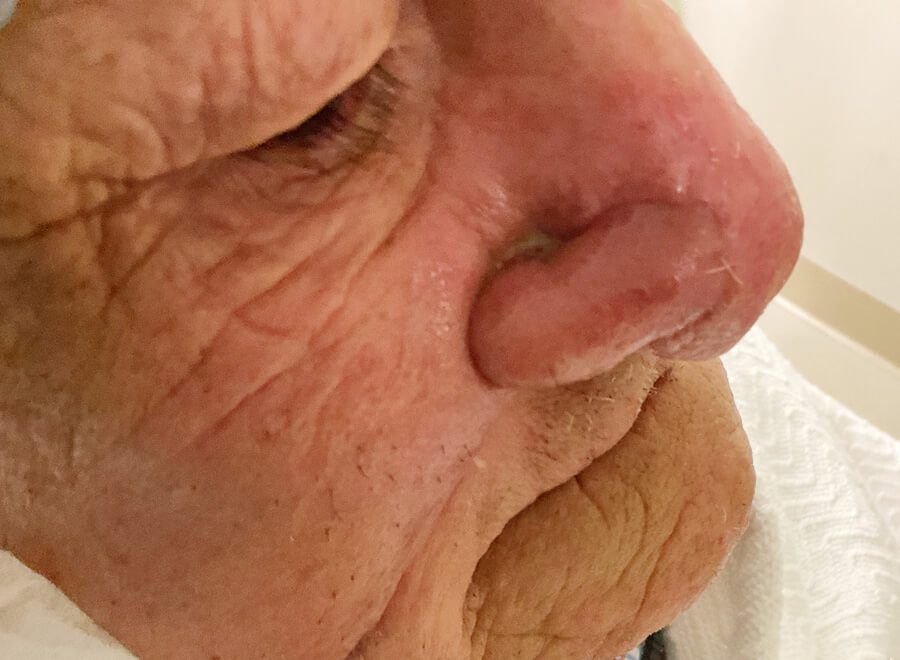 Mohs Nose Patient 27 Before - 3
