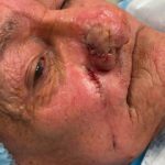 Mohs Nose Patient 27 Thumbnail After - 3