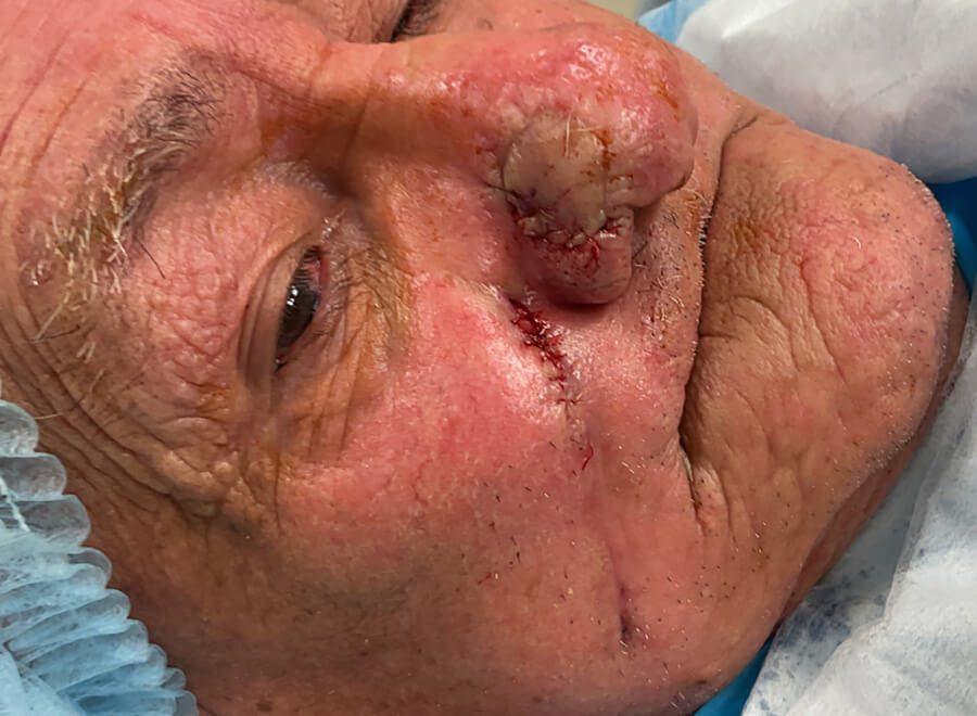 Mohs Nose Patient 27 After - 3