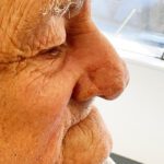 Mohs Nose Patient 27 Thumbnail Before - 4
