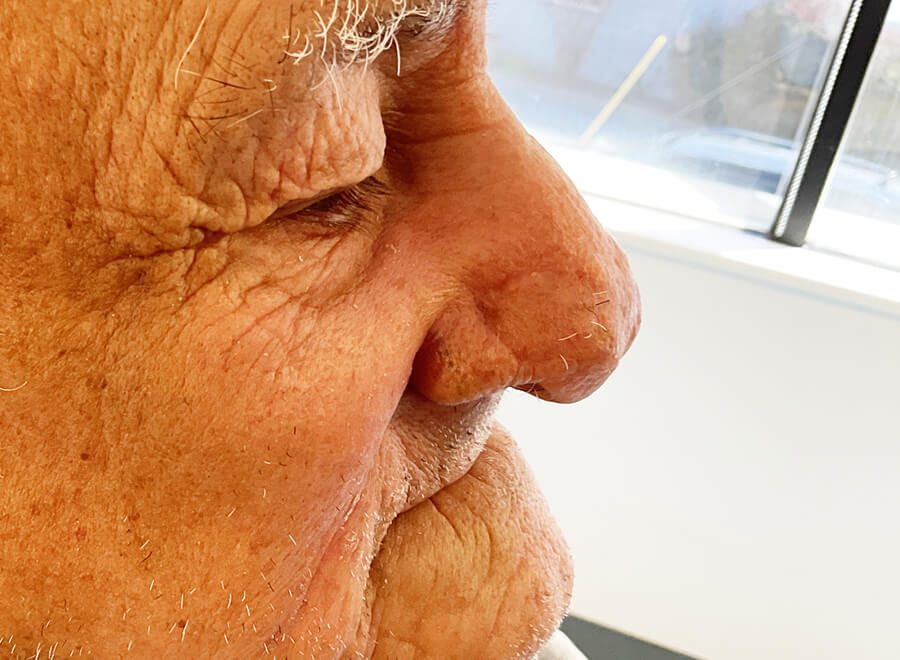 Mohs Nose Patient 27 Before - 4