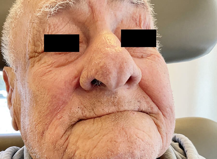 Mohs Nose Patient 27 After - 4