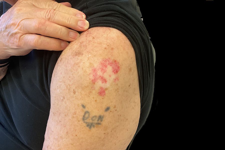 Mohs Arm Patient 01 Before