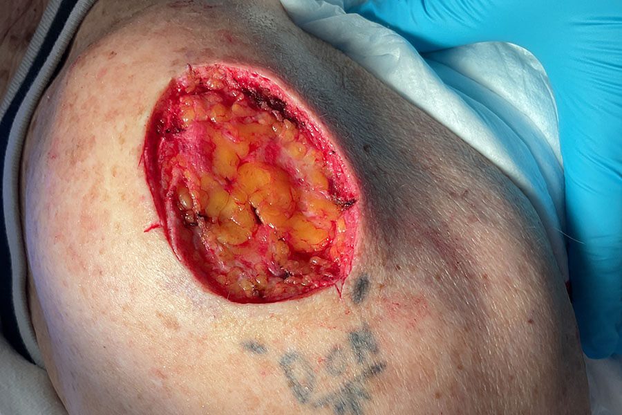 Mohs Arm Patient 01 After