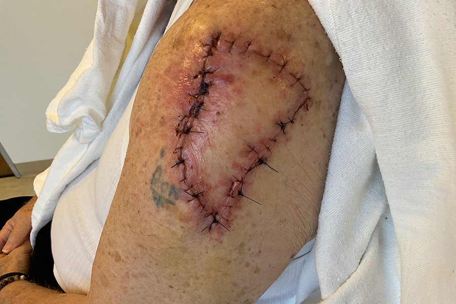 Mohs Arm Patient 01 Before - 2