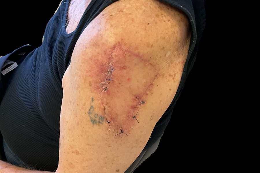 Mohs Arm Patient 01 After - 2