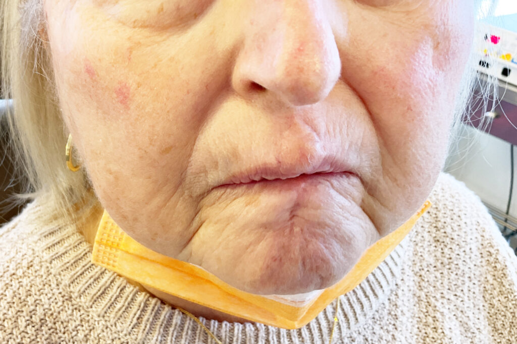 Mohs Lips Patient 14 Before