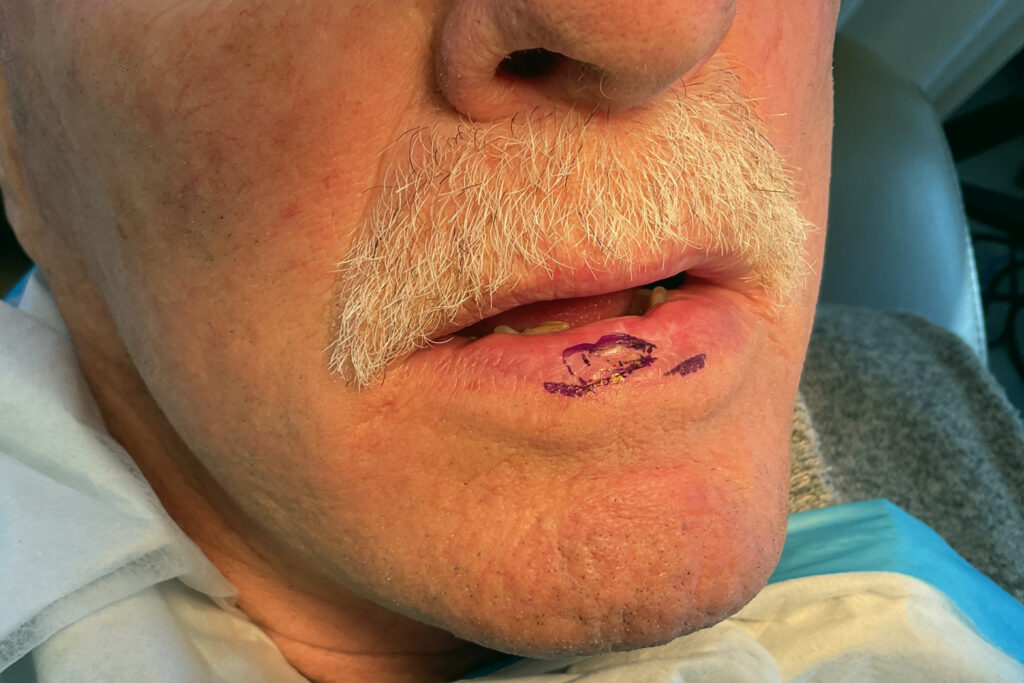 Mohs Lips Patient 15 Before