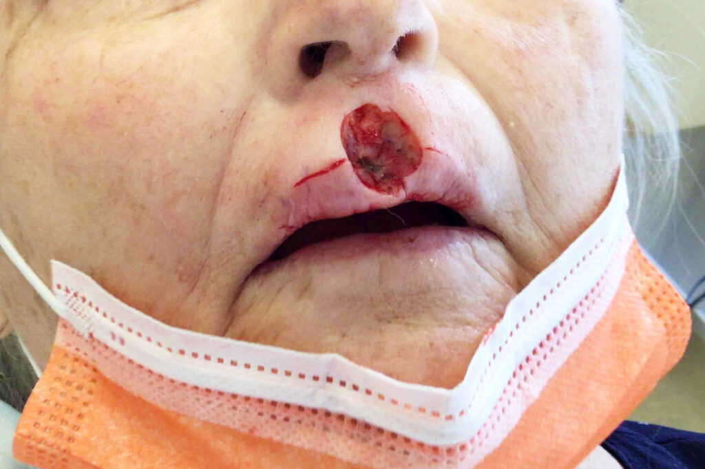 Mohs Lips Patient 14 After