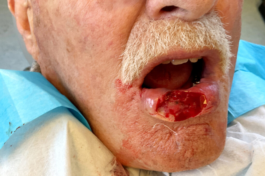 Mohs Lips Patient 15 After