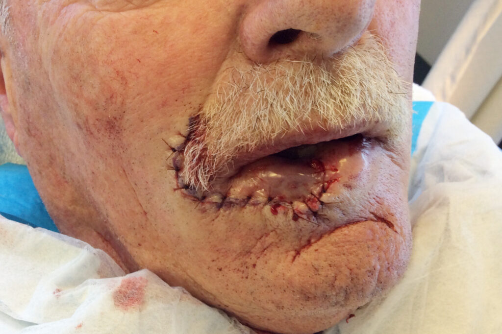 Mohs Lips Patient 15 Before - 2