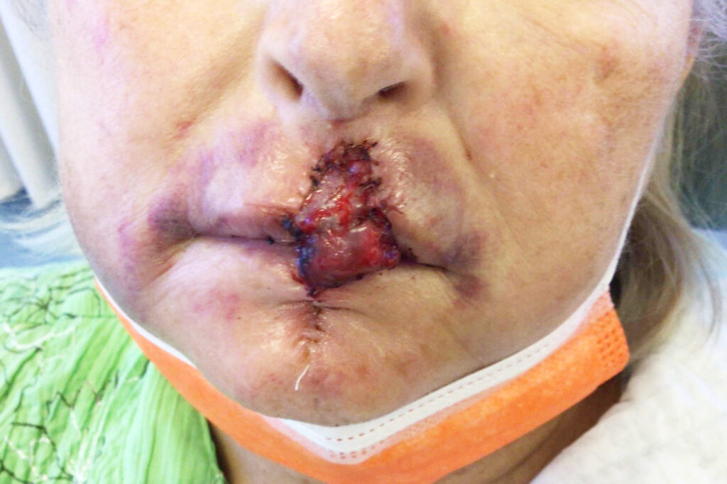 Mohs Lips Patient 14 Before - 2