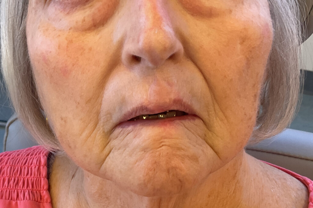 Mohs Lips Patient 14 After - 2