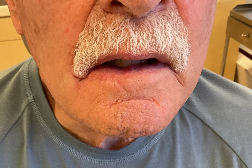 Mohs Lips Patient 15 After - 2