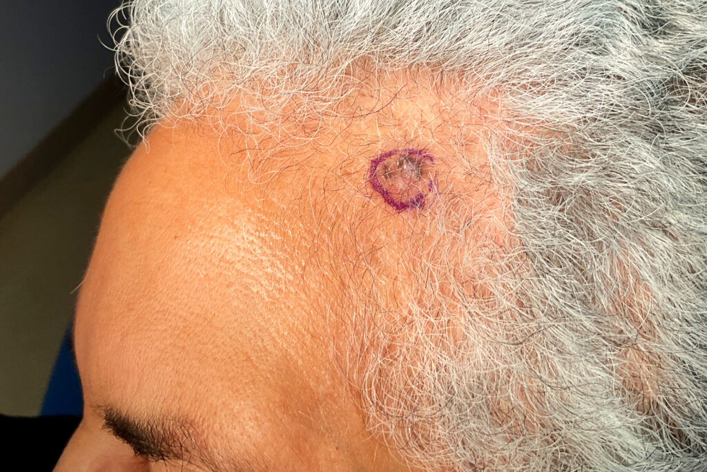 Mohs Patient Scalp 04 Before