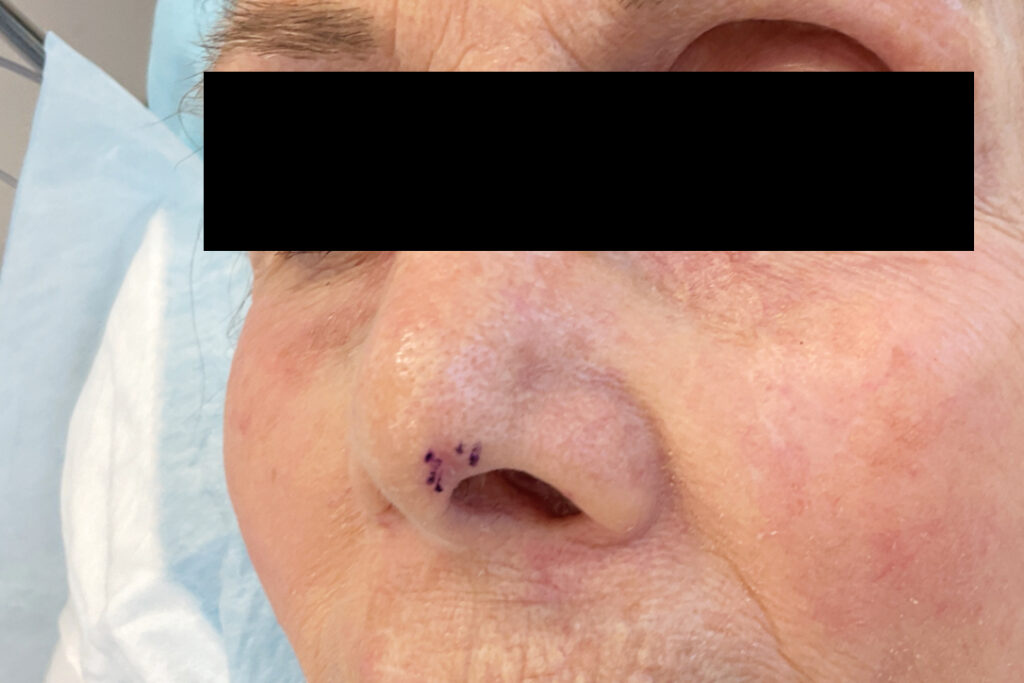 Mohs Nose Patient 29 Before