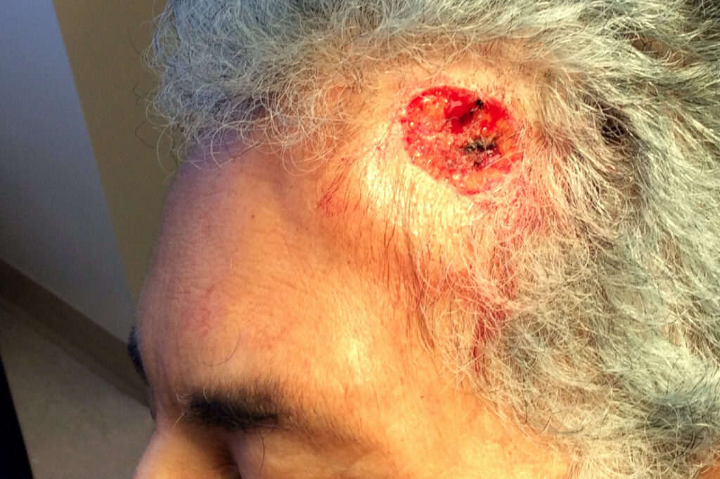 Mohs Patient Scalp 04 After