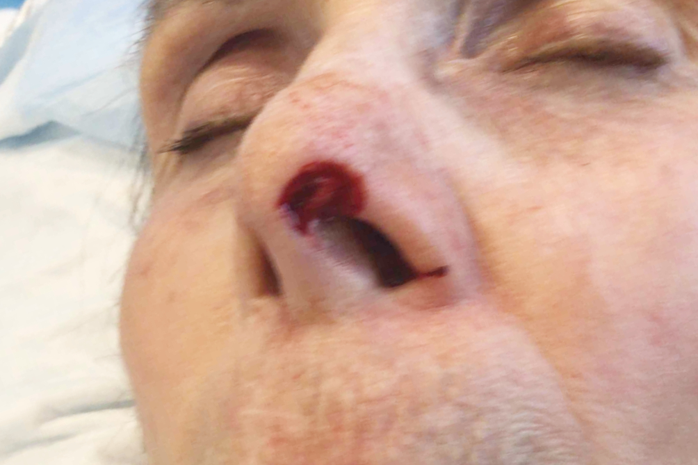 Mohs Nose Patient 29 After