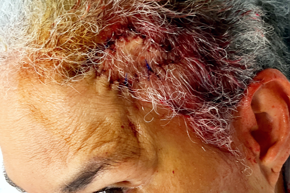 Mohs Patient Scalp 04 Before - 2