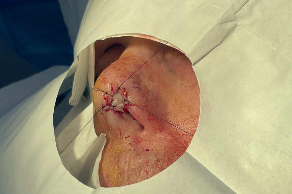 Mohs Nose Patient 29 Before - 2