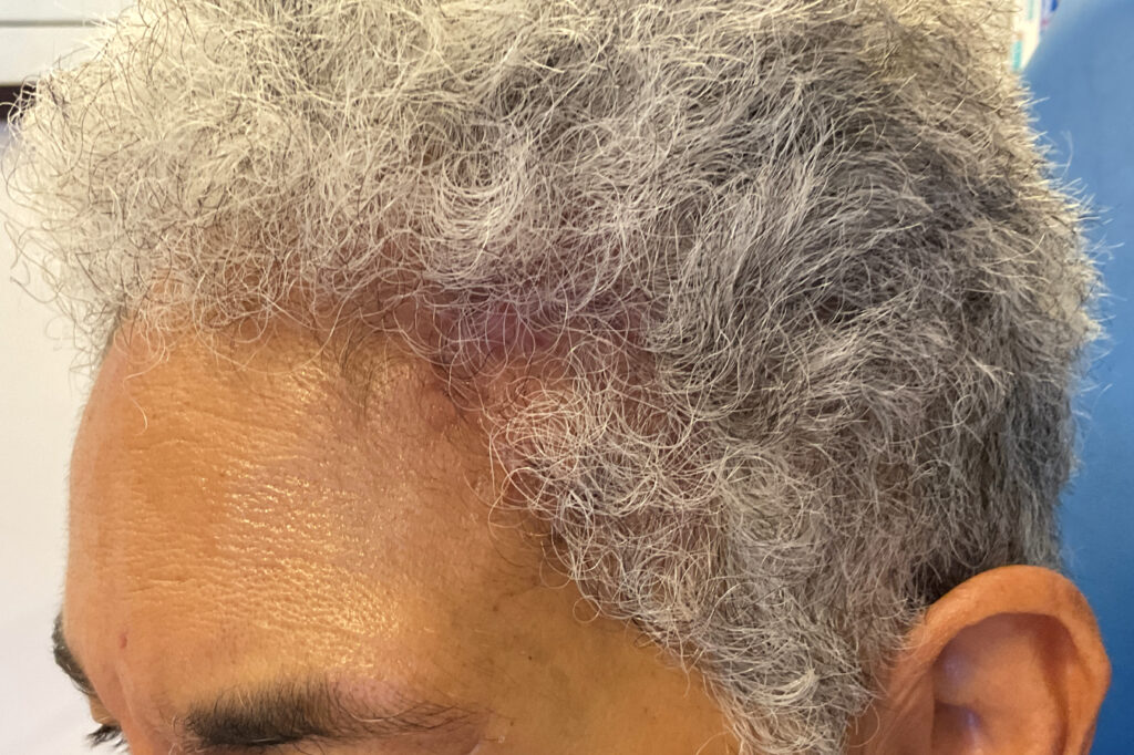 Mohs Patient Scalp 04 After - 2