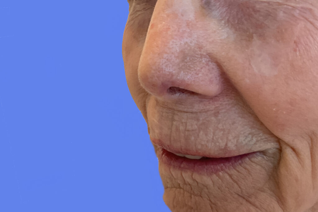 Mohs Nose Patient 29 After - 2