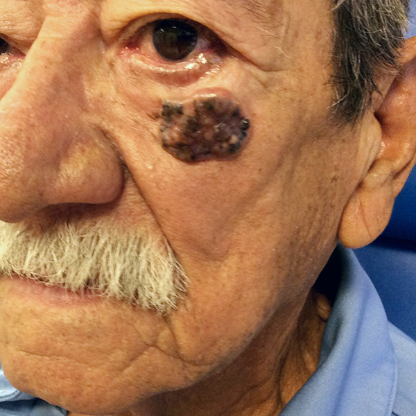 Mohs Eye Patient 08 Before