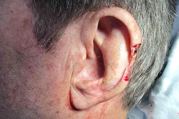 Mohs Ear Patient 13 After