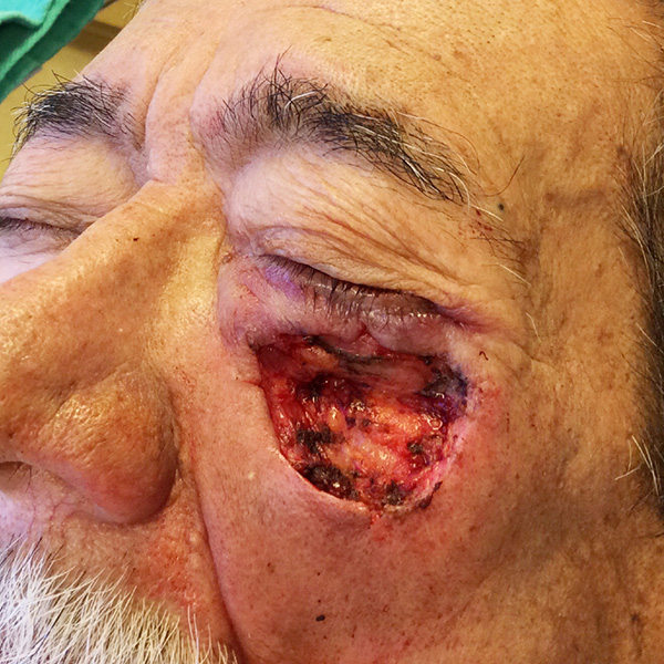 Mohs Eye Patient 08 After