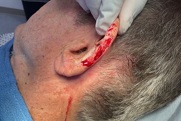 Mohs Ear Patient 13 Before - 2