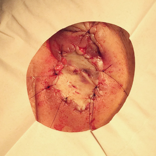 Mohs Eye Patient 08 Before - 2