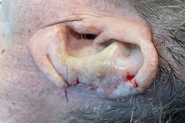 Mohs Ear Patient 13 After - 2