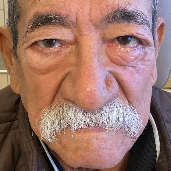 Mohs Eye Patient 08 After - 2