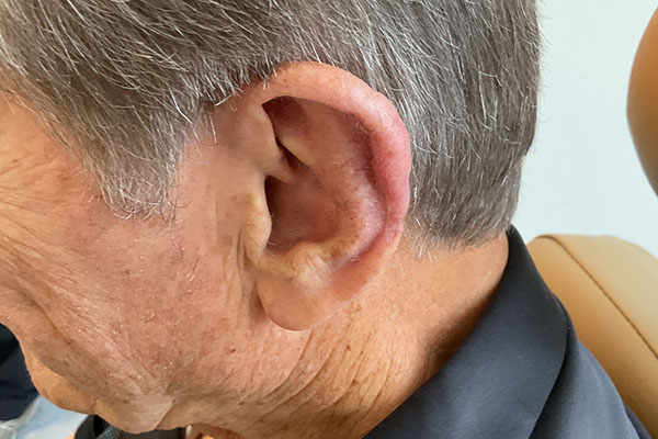 Mohs Ear Patient 13 After - 3