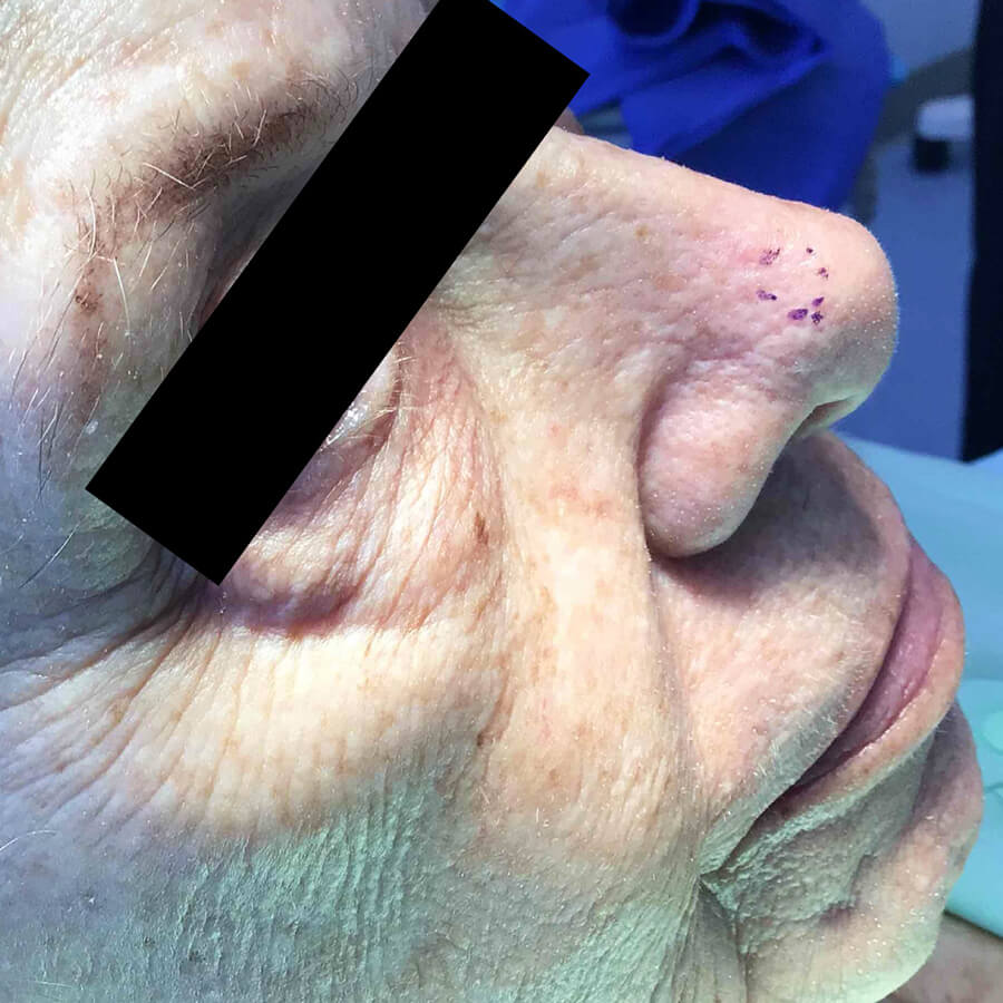 Mohs Nose Patient 30 Before