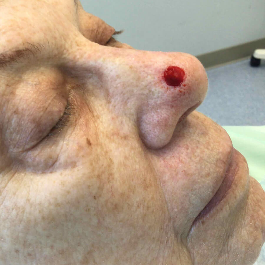 Mohs Nose Patient 30 After