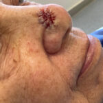 Mohs Nose Patient 30 Thumbnail Before - 2