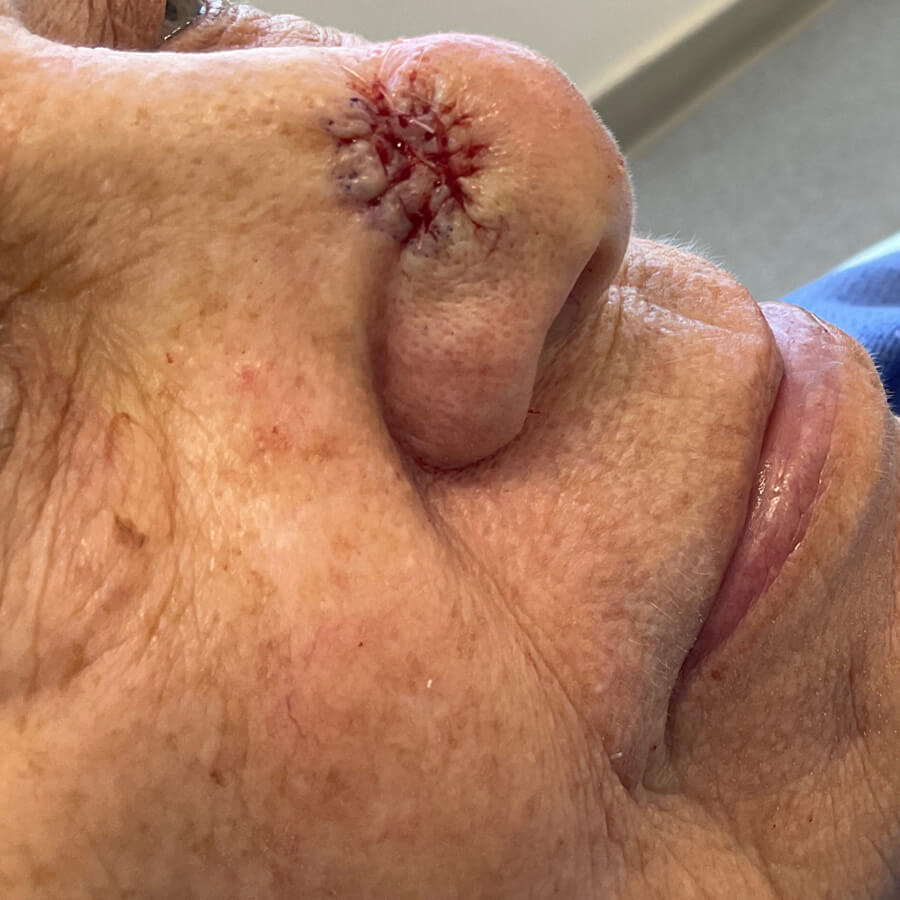 Mohs Nose Patient 30 Before - 2