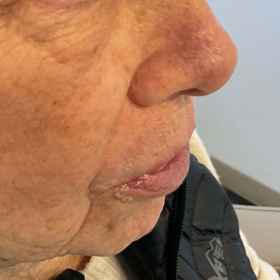 Mohs Nose Patient 30 After - 2