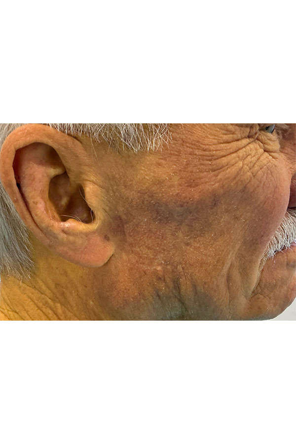 Mohs Face Patient 22 After - 2